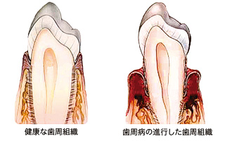 歯周病の進行