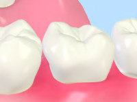 歯周病について