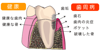 歯周病（歯槽膿漏）ってどんな病気