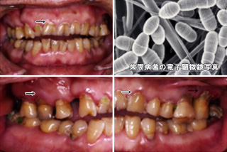 歯周病の原因1