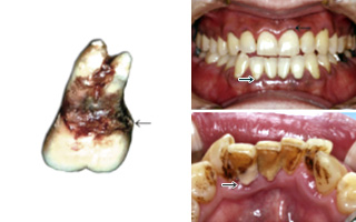 歯周病の原因2
