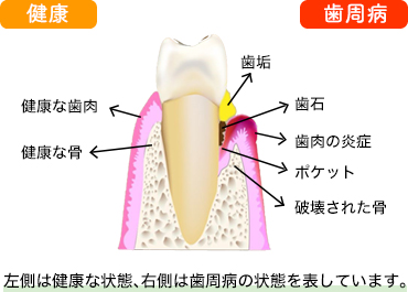 【ブログ】歯周病とは？歯周病ってどんな病気？（原因・進行過程）