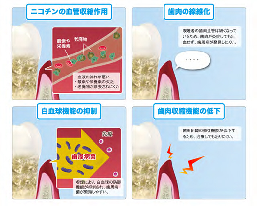 歯周病と煙草の関係2