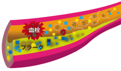 血管内に発生するプラーク