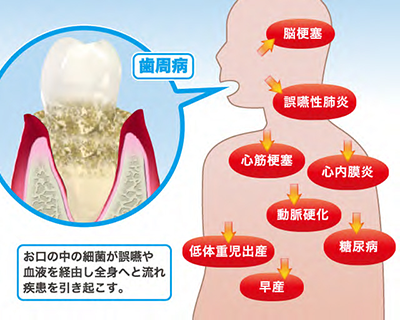 日本臨床歯周病学会 歯周病が全身に及ぼす影響